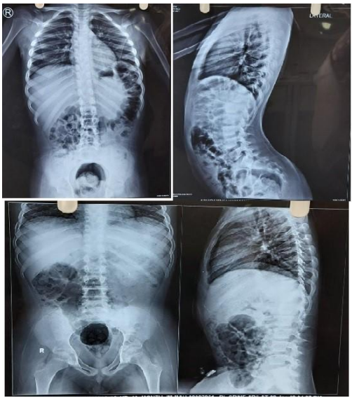 X-Ray (Pre and Post treatment)